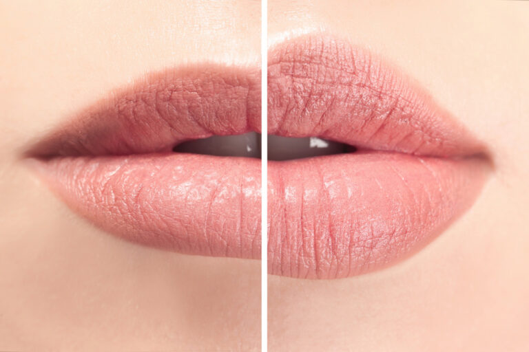 Aumento de labios en Zaragoza