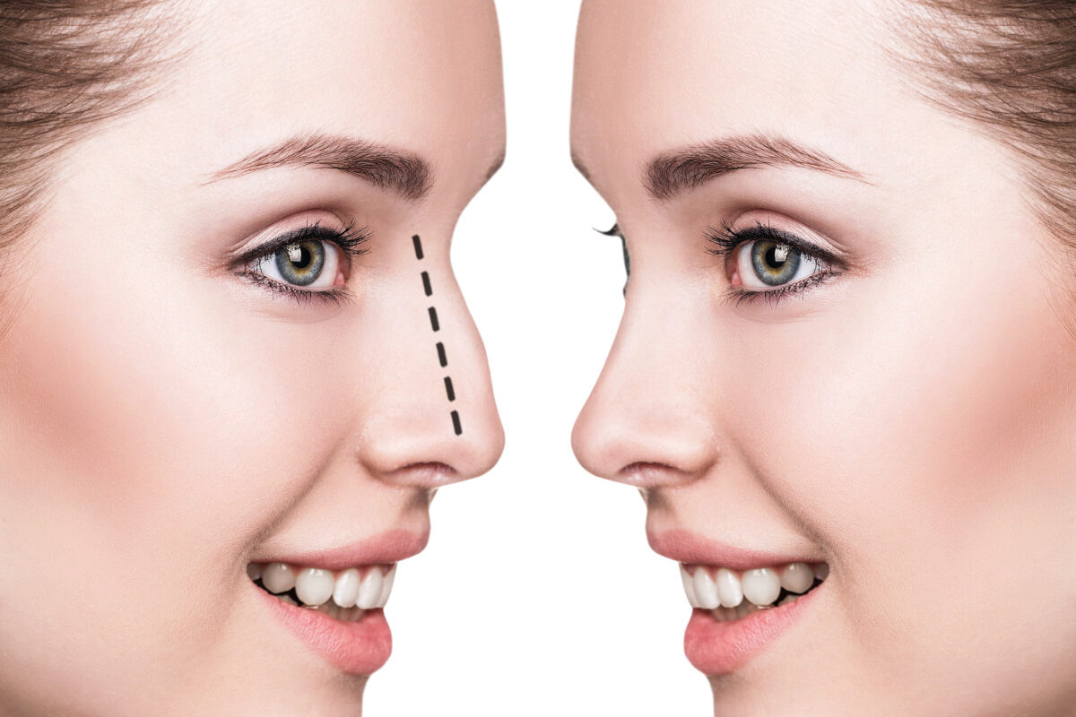 rinoplastia
