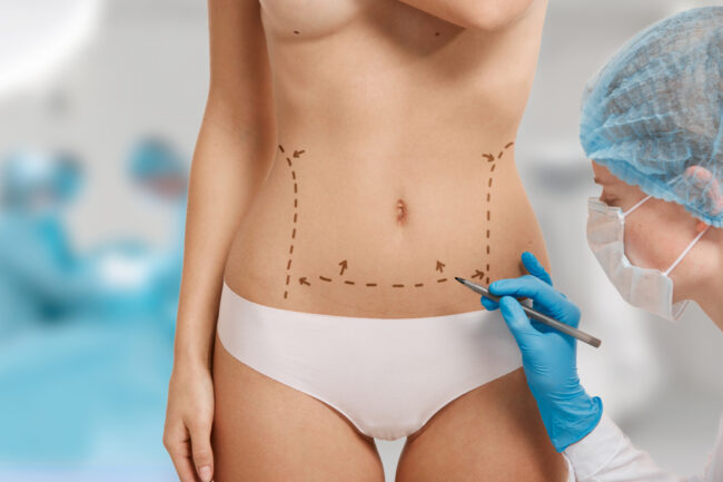 abdominoplastia zaragoza