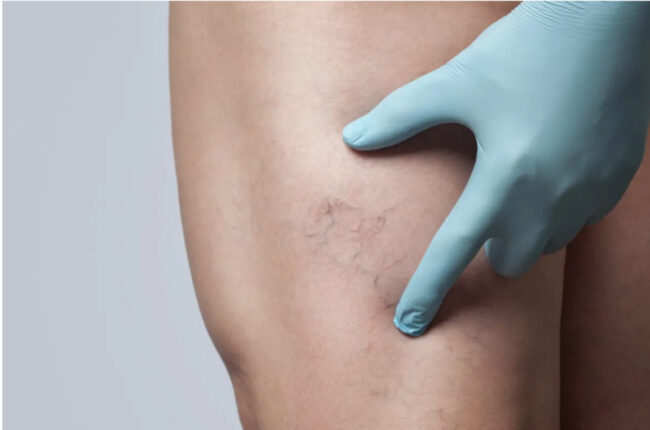 esclerosis de arañas vasculares