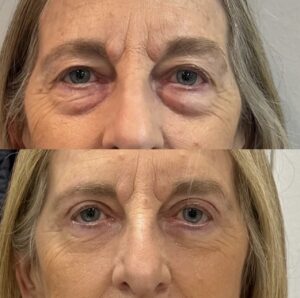 Blefaroplastia